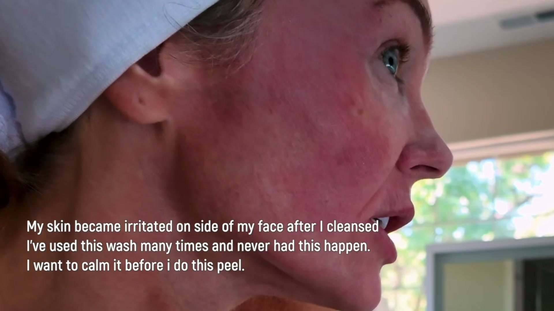 Close-up of one-sided facial redness referenced during Kim's earlier Glow Stack period