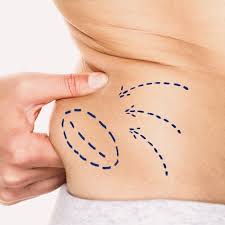 FAT DISSOLVERS | LIPOLYSIS INJECTIONS