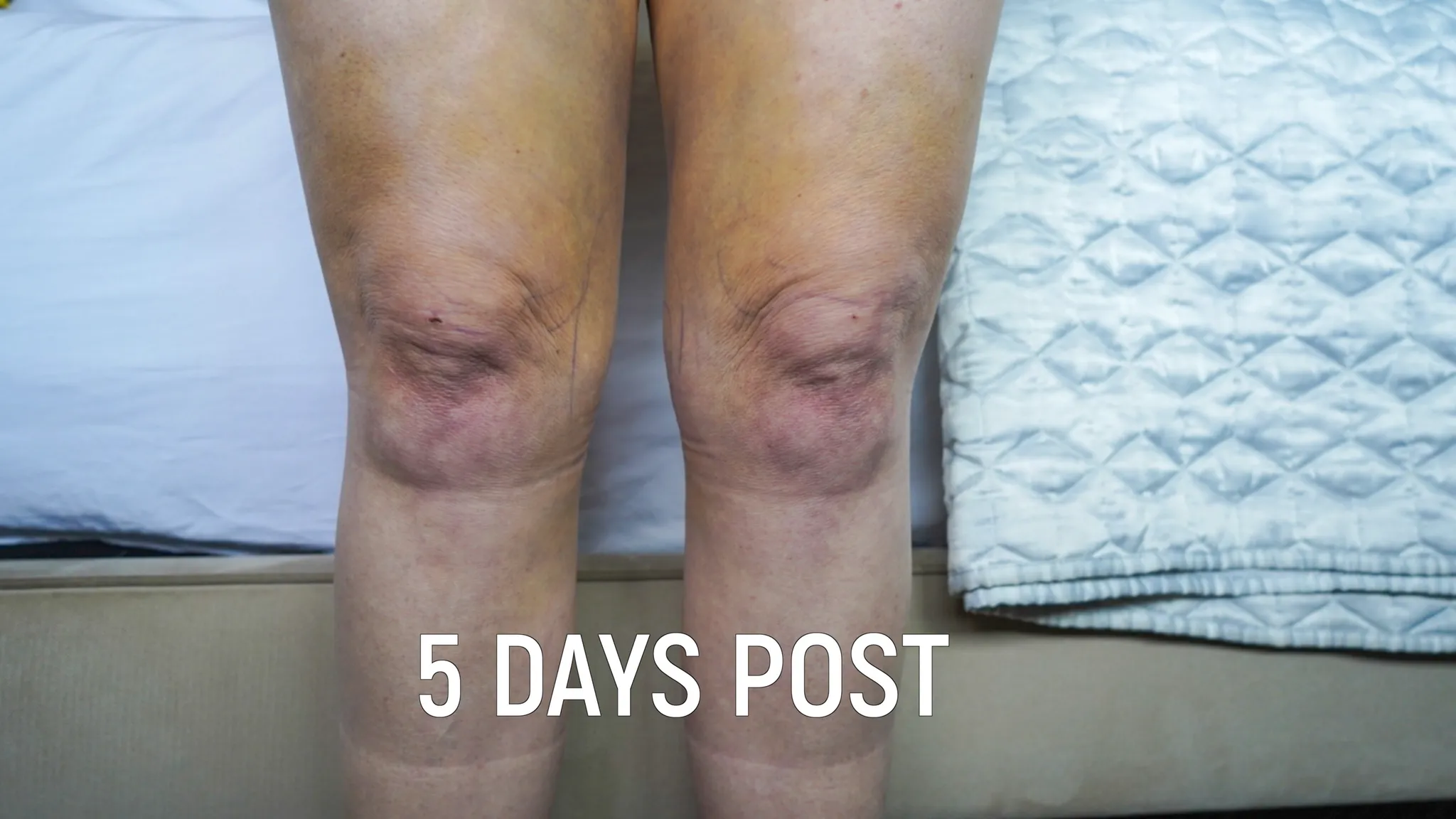 Do I Need a Facelift? Join Me for My Consultation Experience & Cost! - treatment image