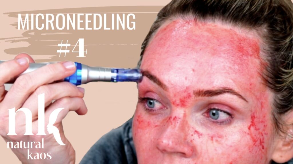 Microneedling Session 4: full treatment and progress