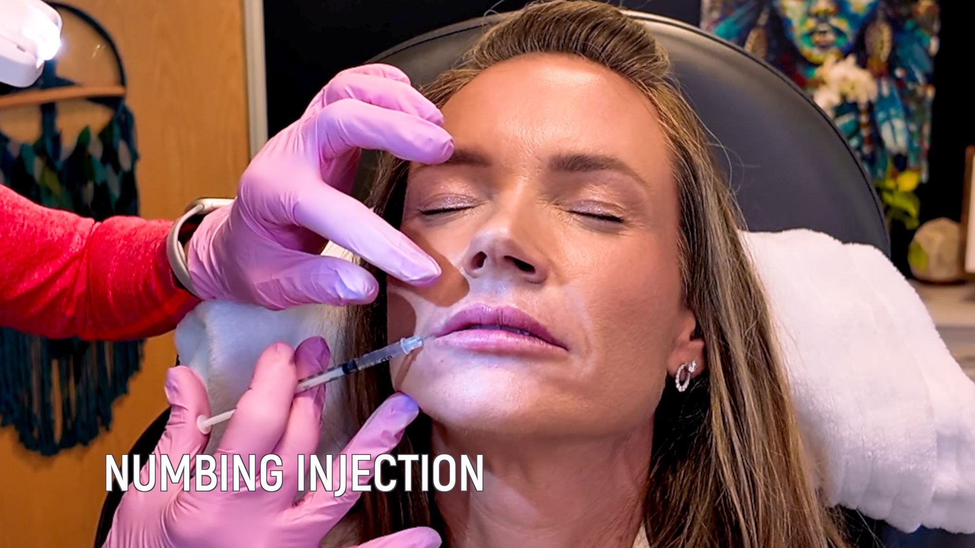 Restylane Kysse Lip Filler: Why the Cannula Method is a Game Changer! - treatment image