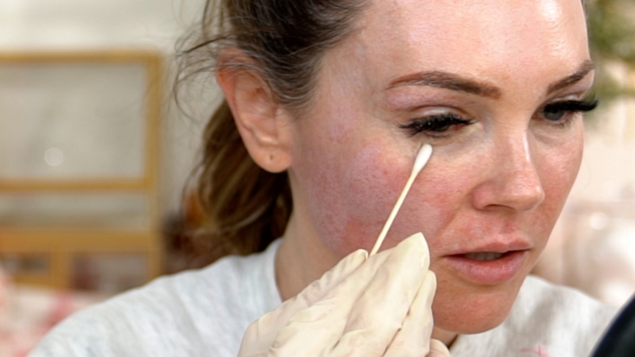 30% TCA PEEL PART 1 – APPLICATION - treatment image