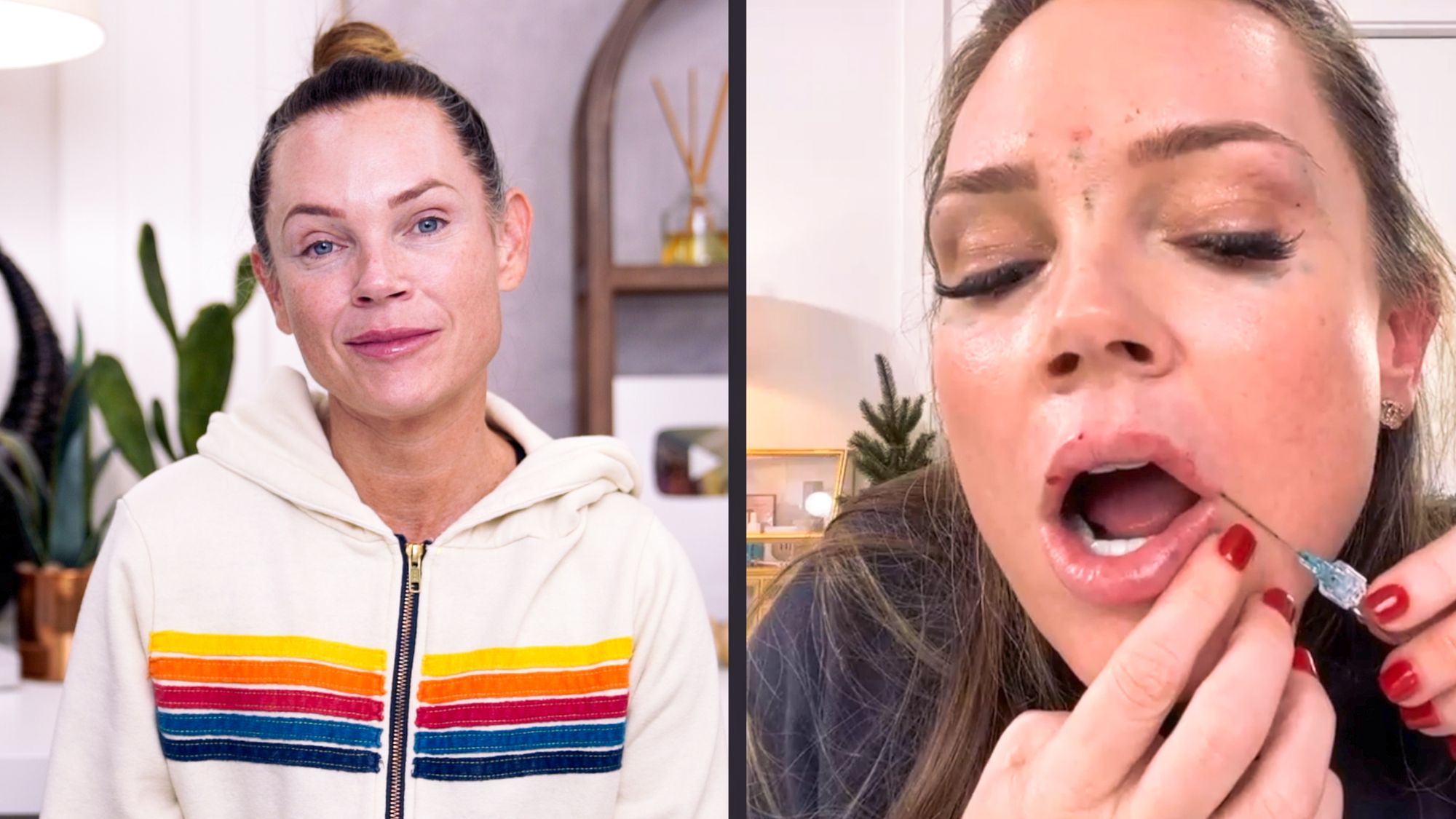 Restylane Kysse Lip Filler: Why the Cannula Method is a Game Changer!