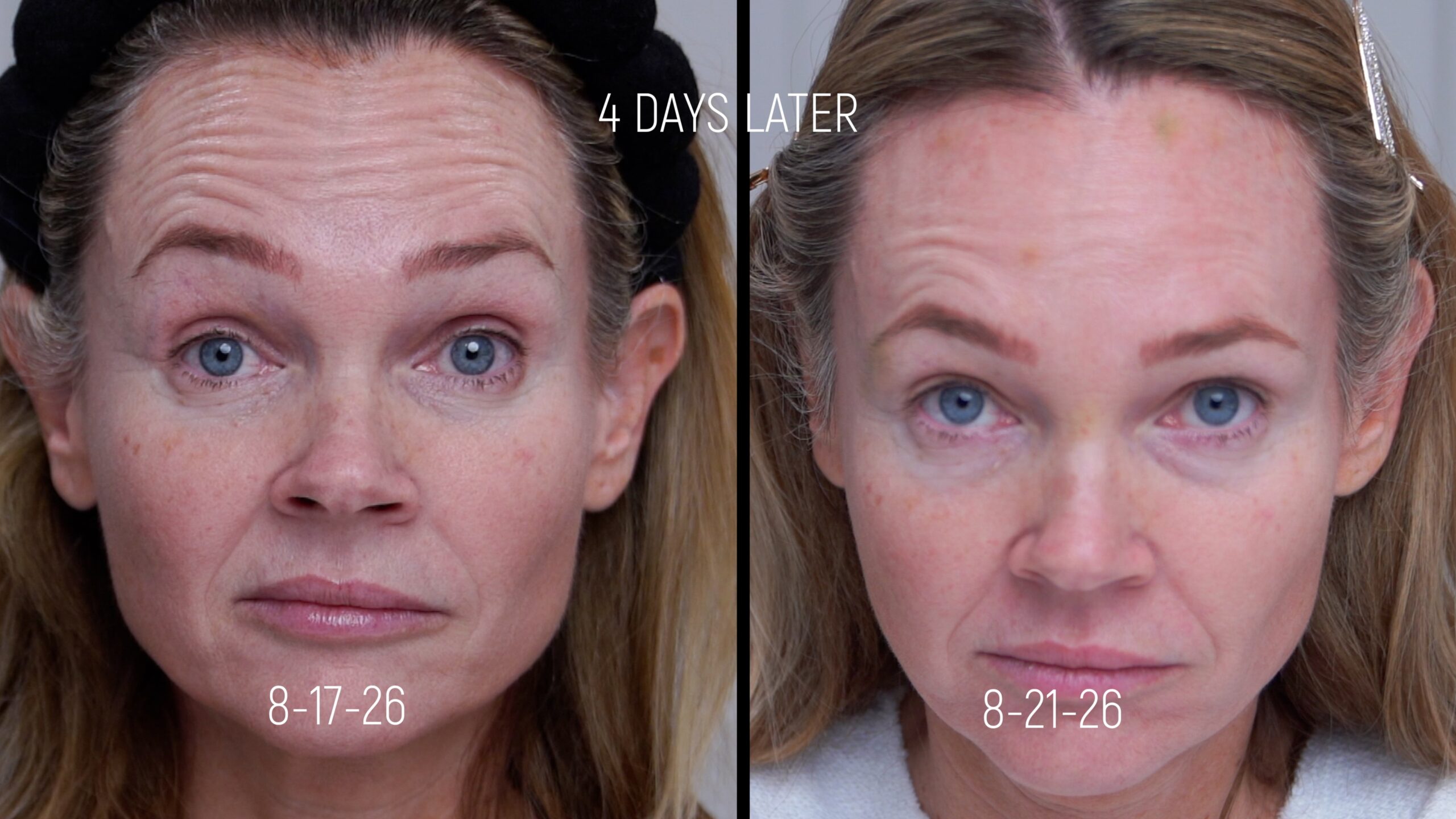 Before and four-day comparison of Kim Pratt raising her brows after Russian Tox placement