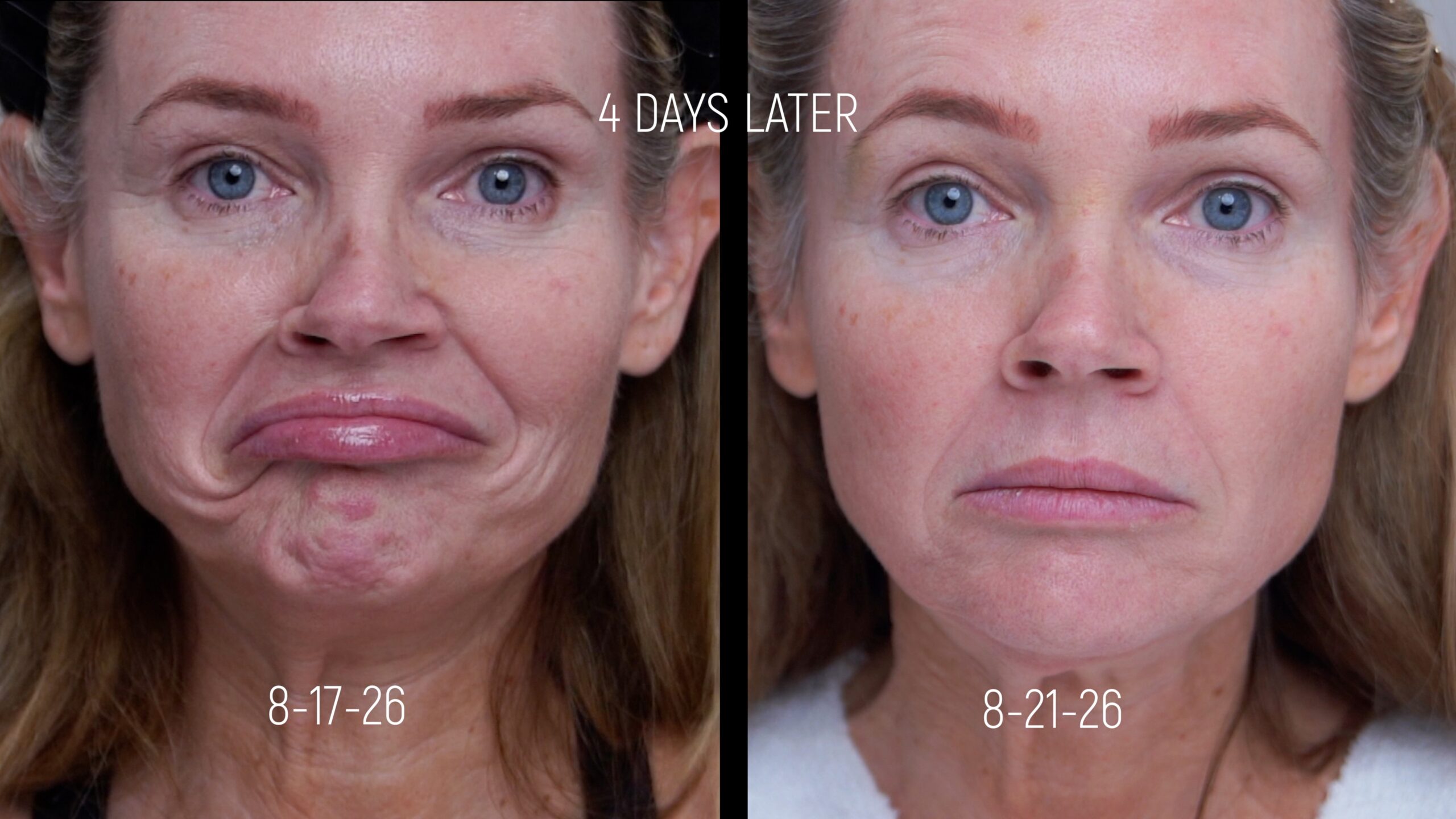 Kim Pratt's before and four-day comparison while pulling down the corners of her mouth
