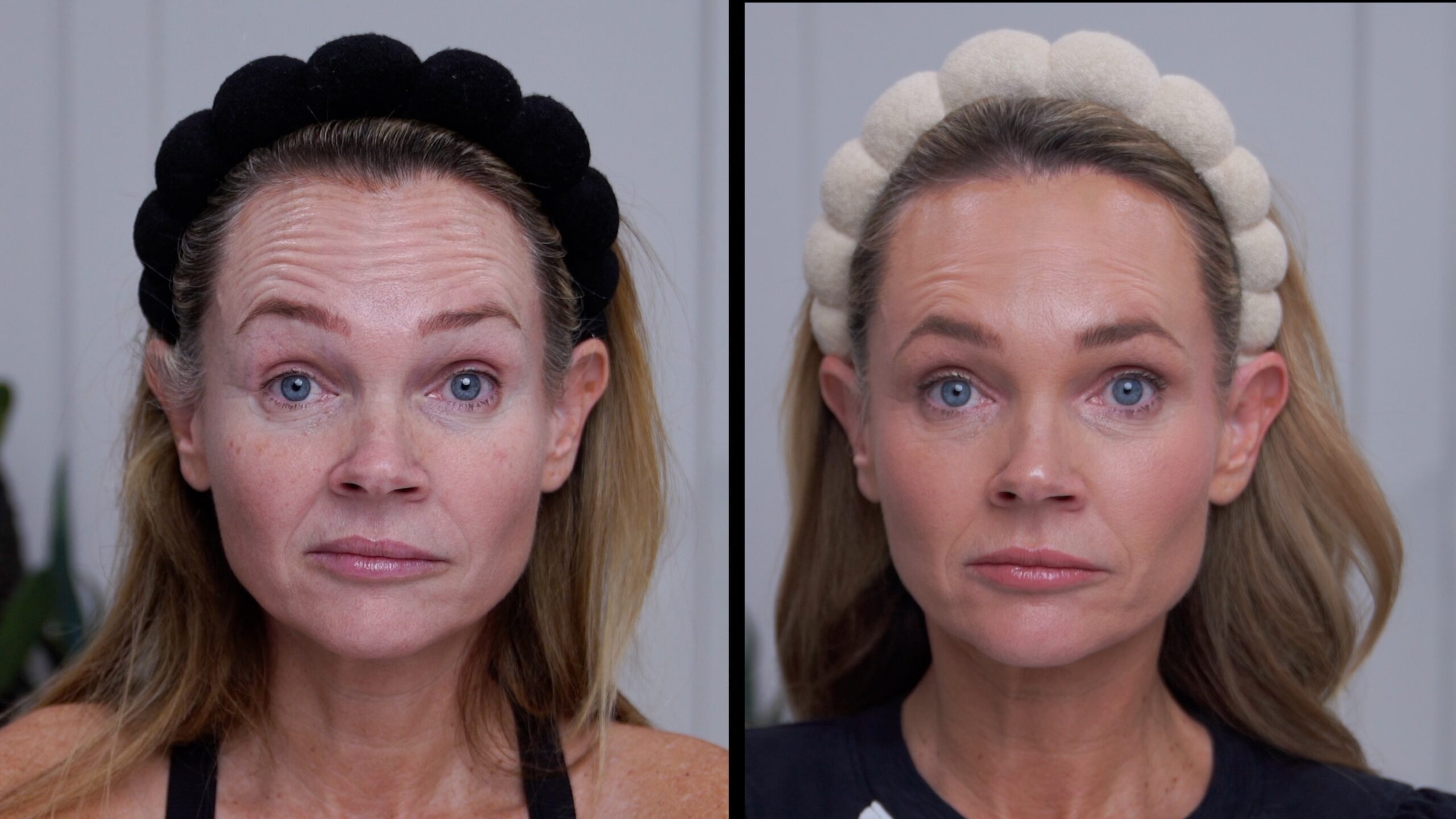Kim Pratt's frontalis movement before and seven days after Russian Tox placement