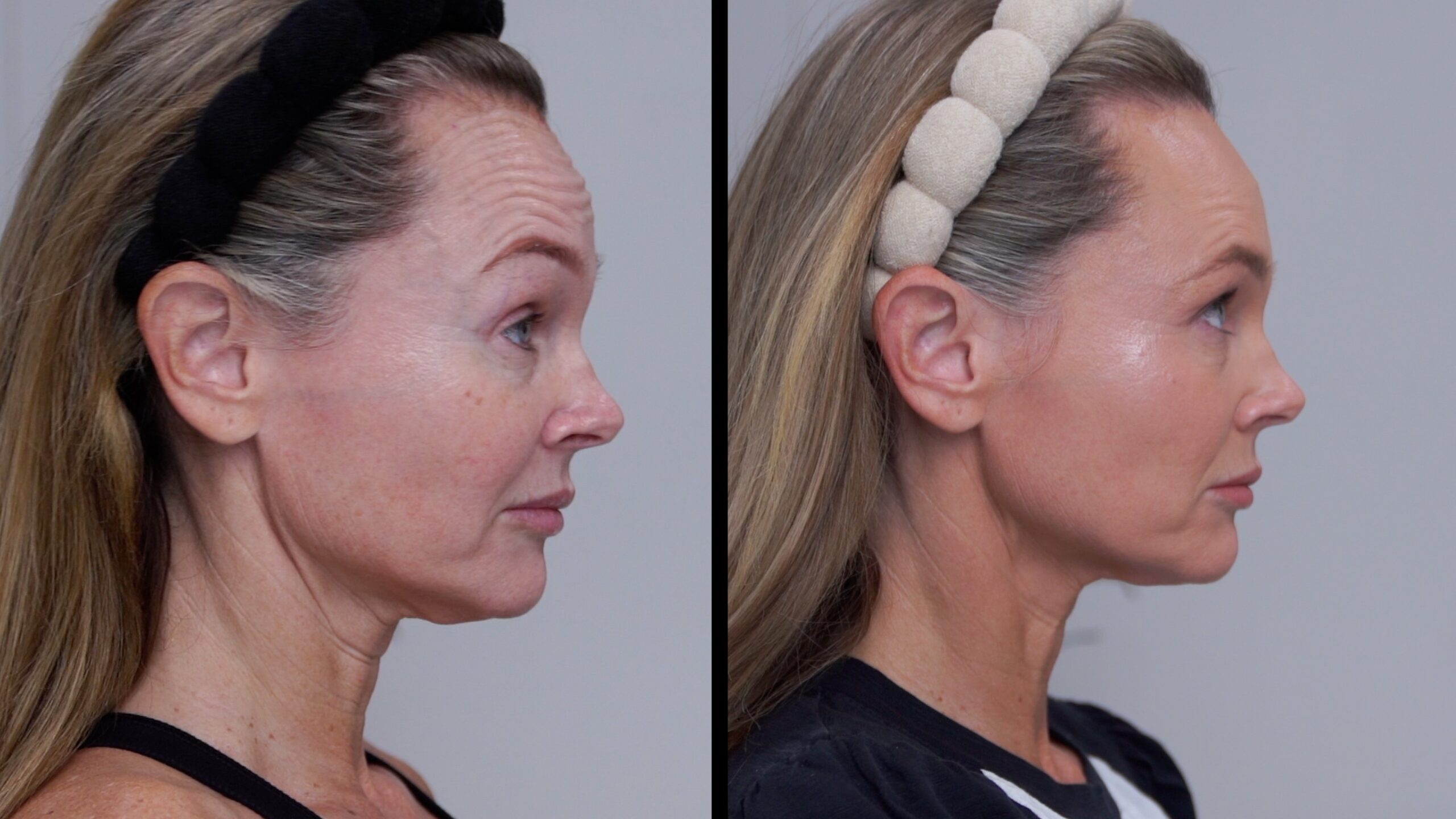 Side-profile comparison of Kim Pratt before and seven days after Russian Tox placement