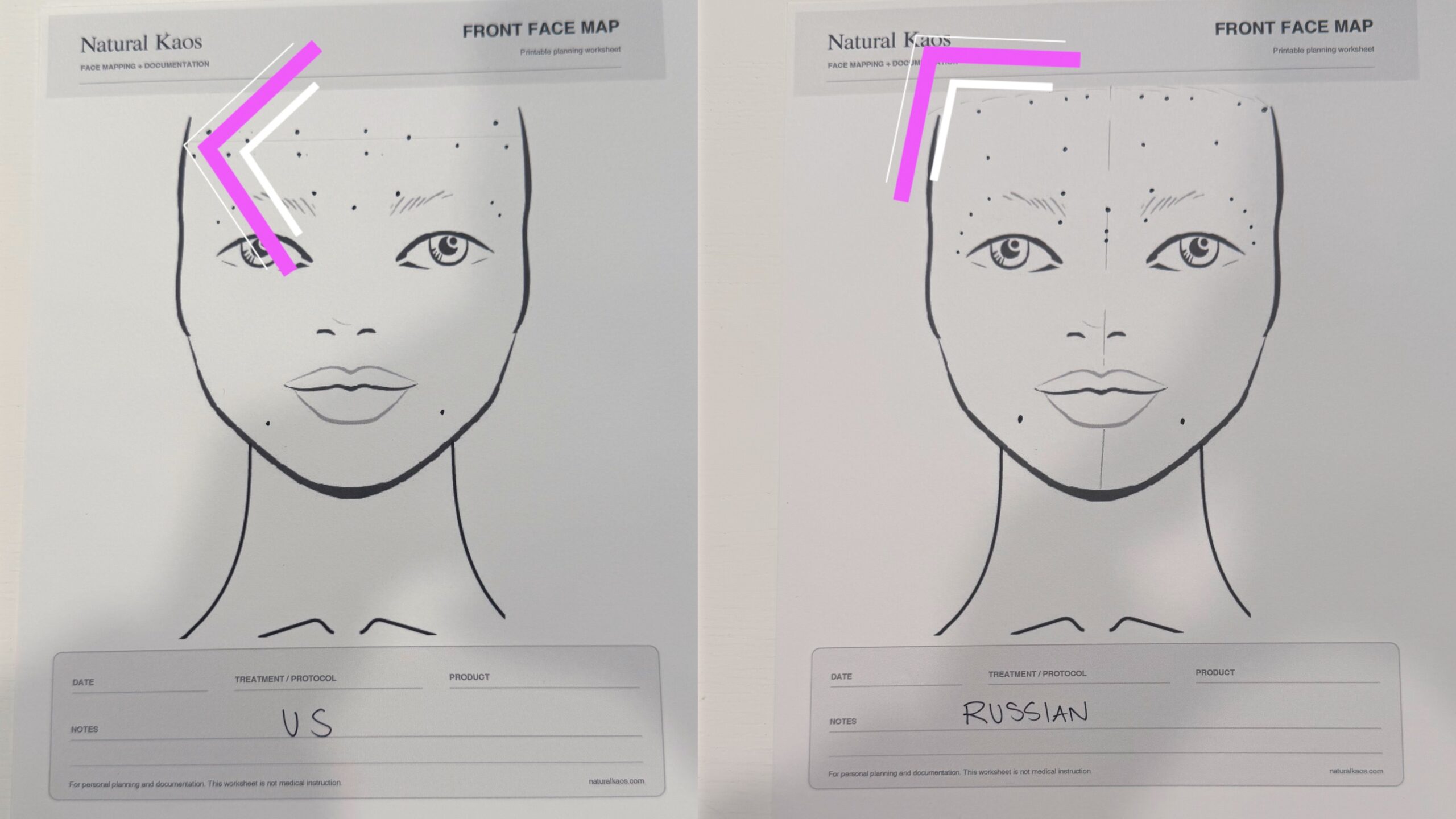 Kim Pratt's visual comparison of Russian Tox and traditional US toxin placement concepts