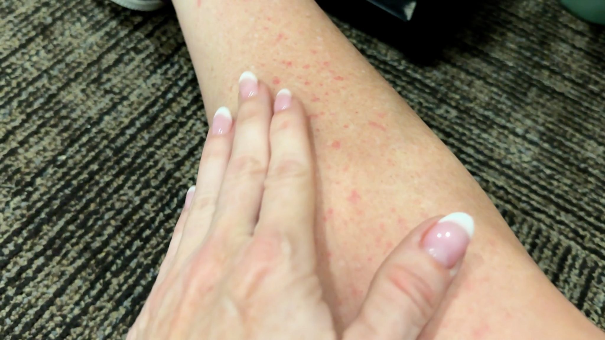 Using Melanotan to Prevent Polymorphous Light Eruption aka SUN POISONING - treatment image