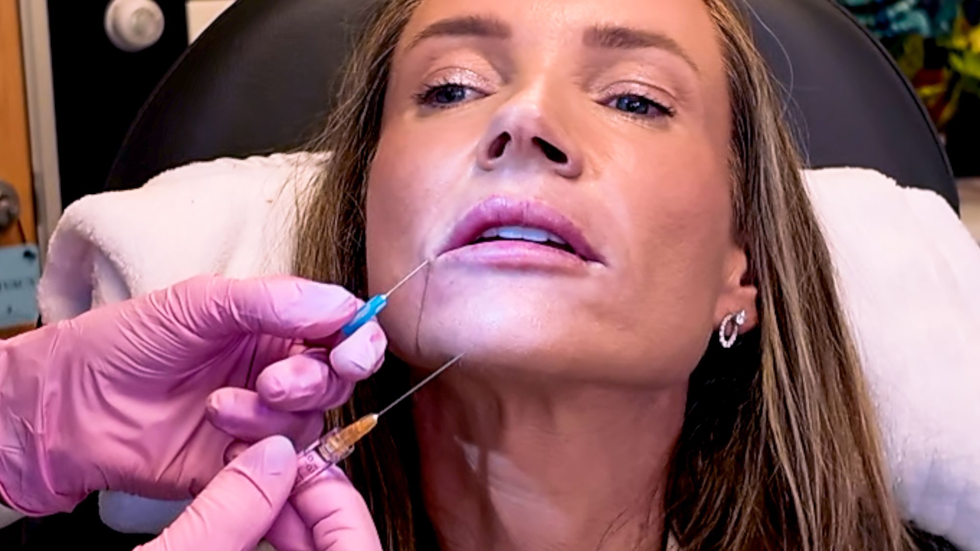 Restylane Kysse Lip Filler: Why the Cannula Method is a Game Changer! - treatment image