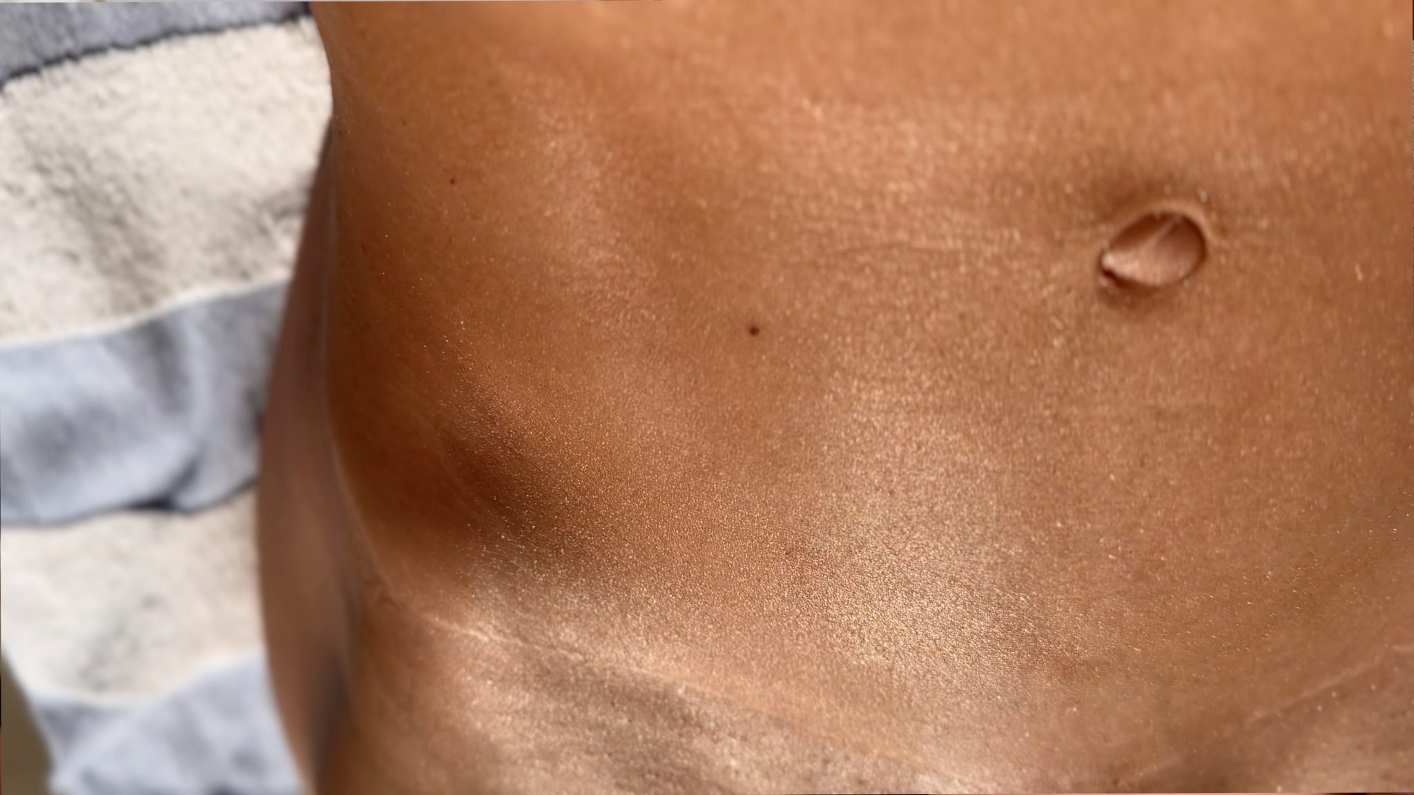 Using Melanotan to Prevent Polymorphous Light Eruption aka SUN POISONING - treatment image