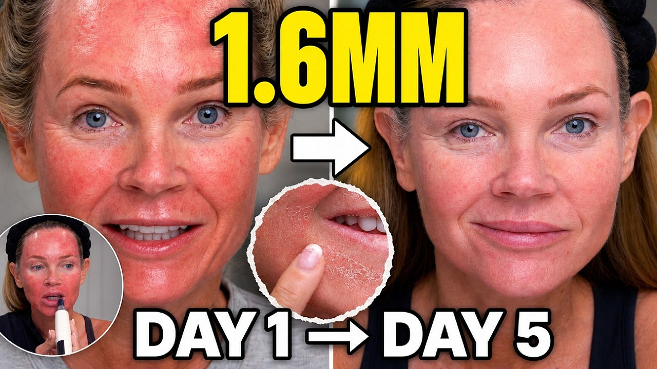 Microneedling With My Dr. Pen M9: My 1.6 mm Recovery Day by Day