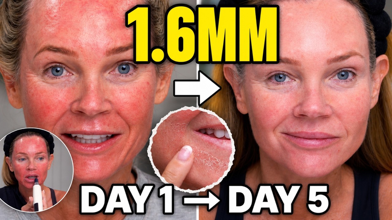 Microneedling With My Dr. Pen M9: My 1.6 mm Recovery Day by Day