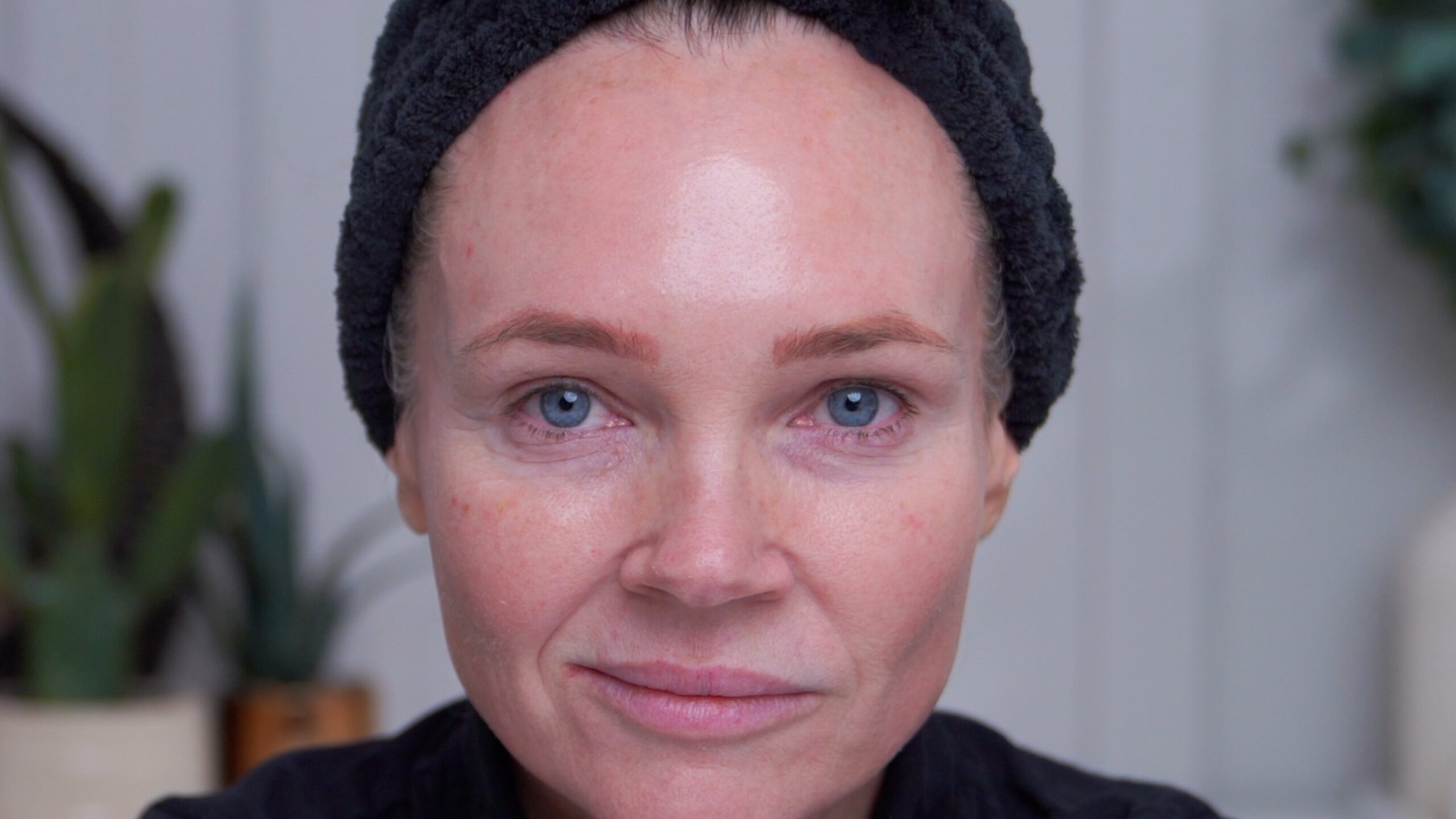 Day 0 immediately after my 25 percent TCA face peel