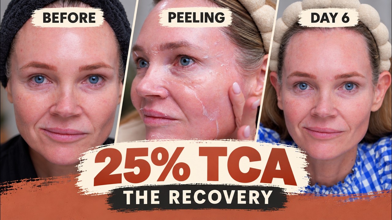 My First 25% TCA Face Peel: Day-by-Day Recovery