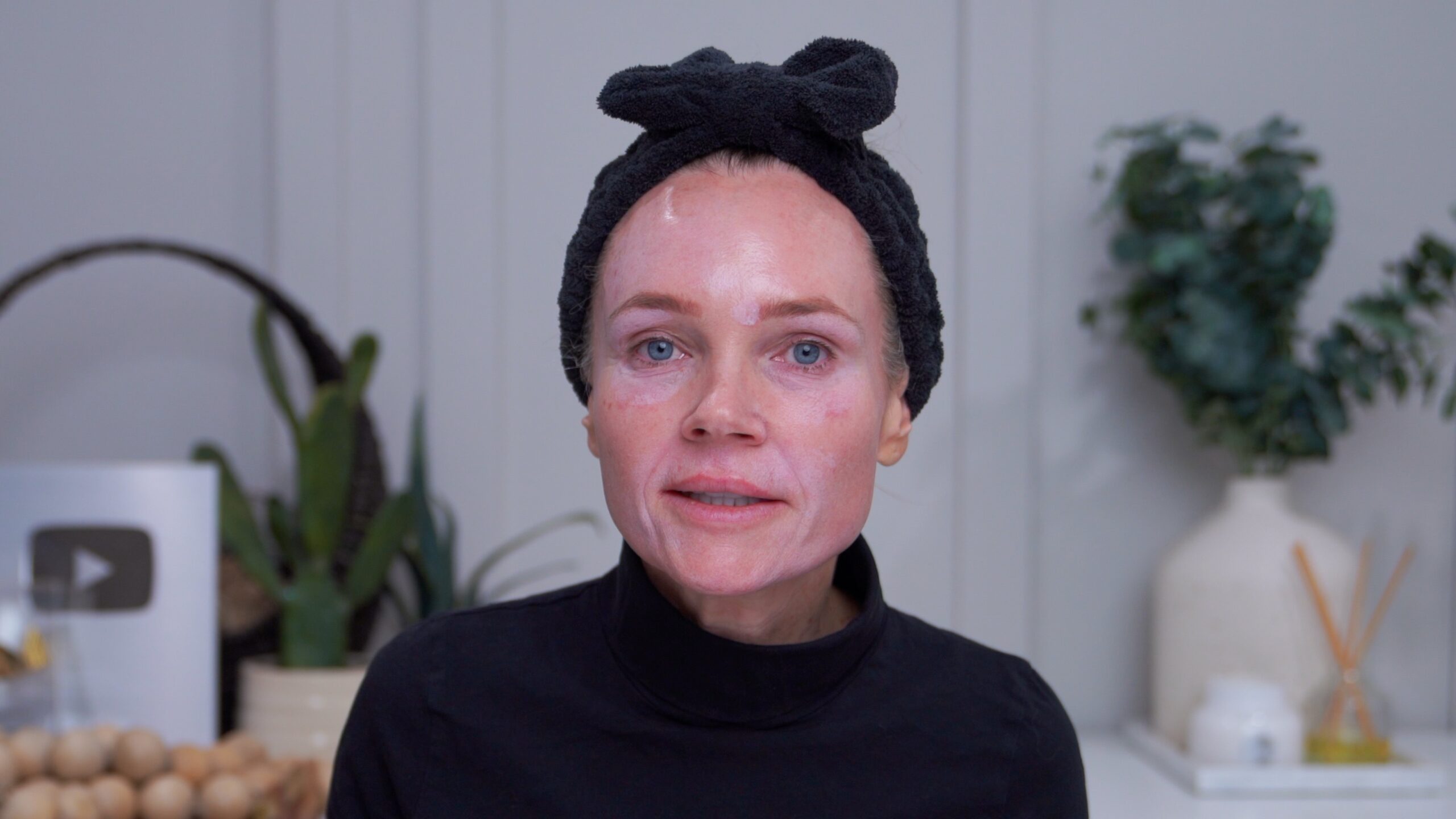 My face showing visible frosting after the 25 percent TCA peel