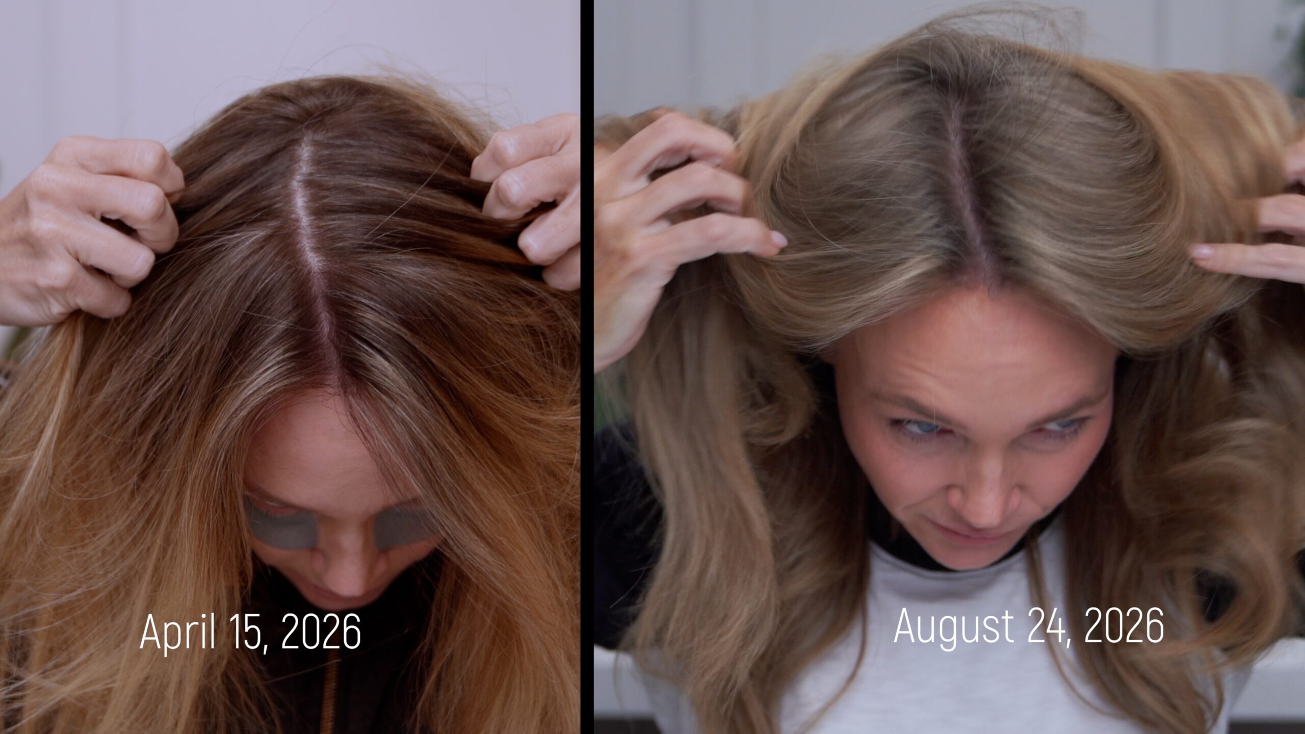 Kim Pratt's April and August 2026 crown comparison during her documented scalp-treatment journey