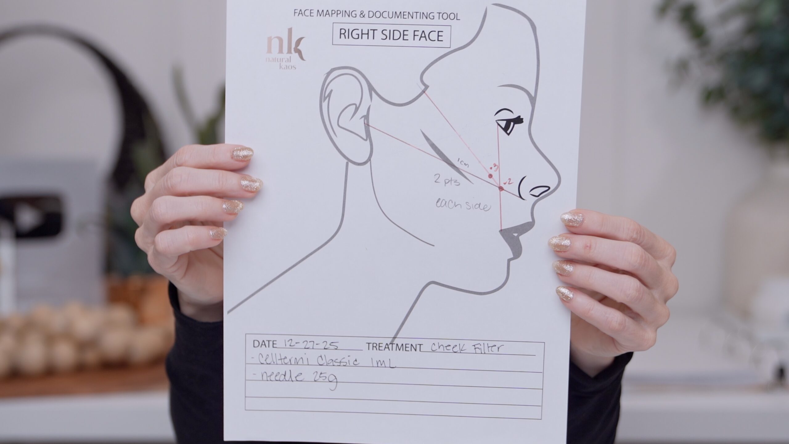 Kimberly holding her completed Natural Kaos right-side face map for her cheek filler treatment