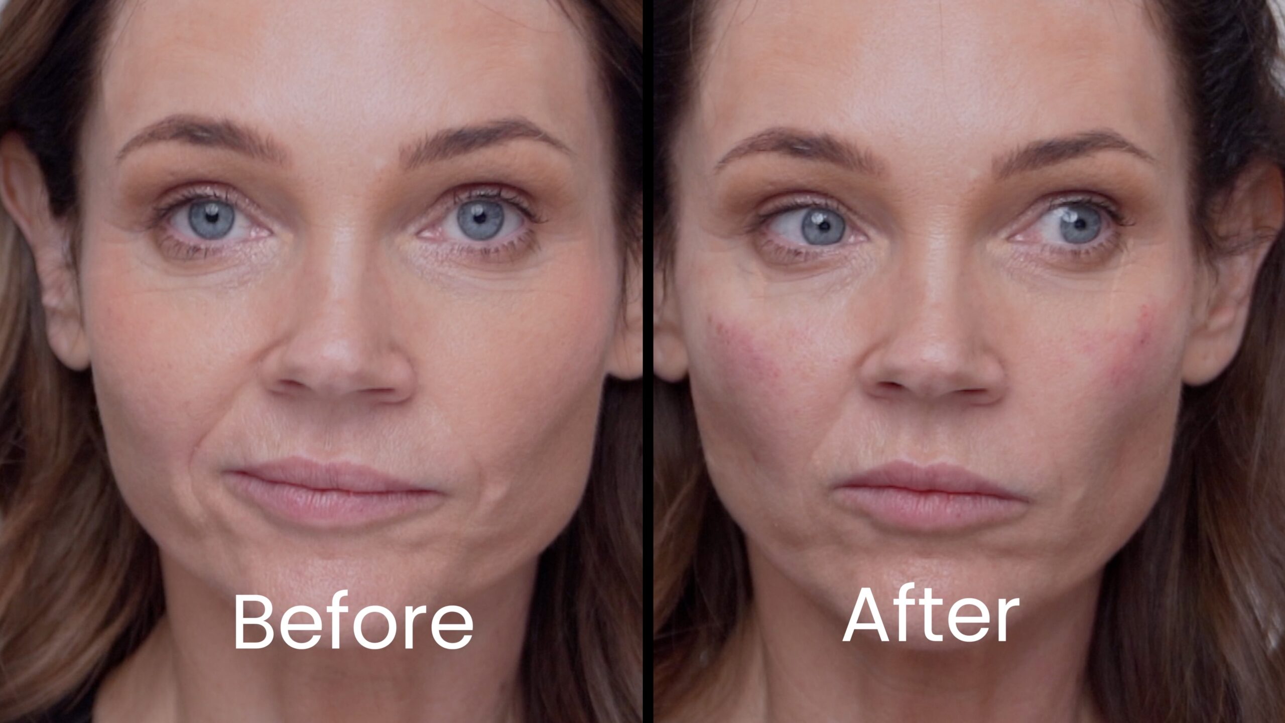 Side-by-side photos of Kimberly before and immediately after her first cheek filler treatment
