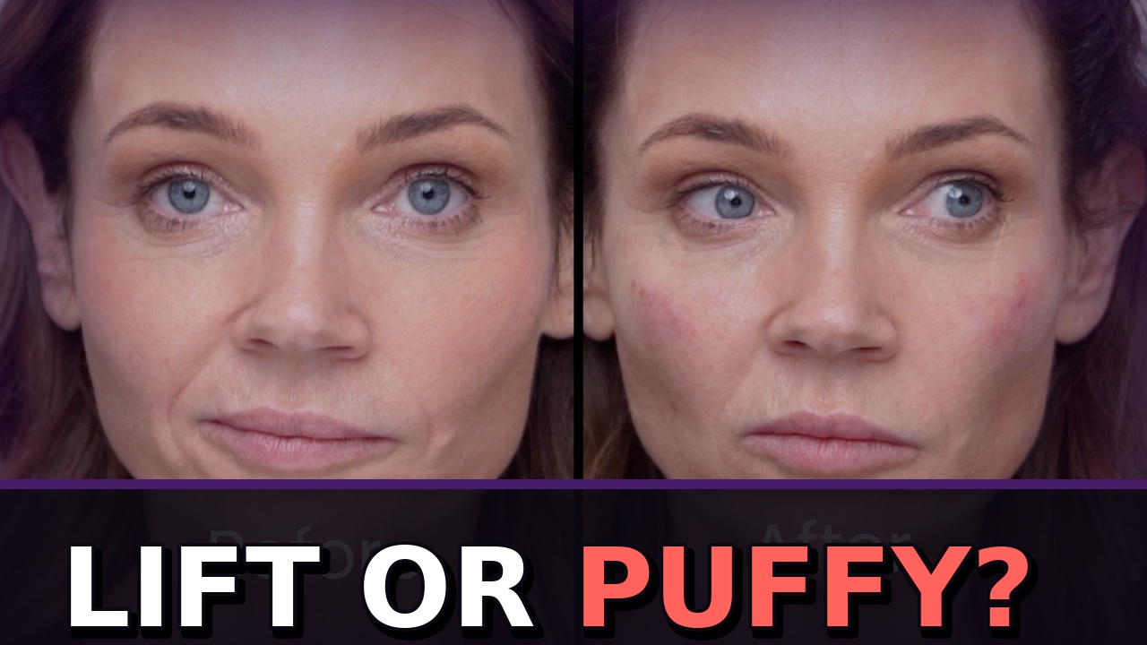 I Added Cheek Filler for Lift—Did It Make Me Look Puffy?
