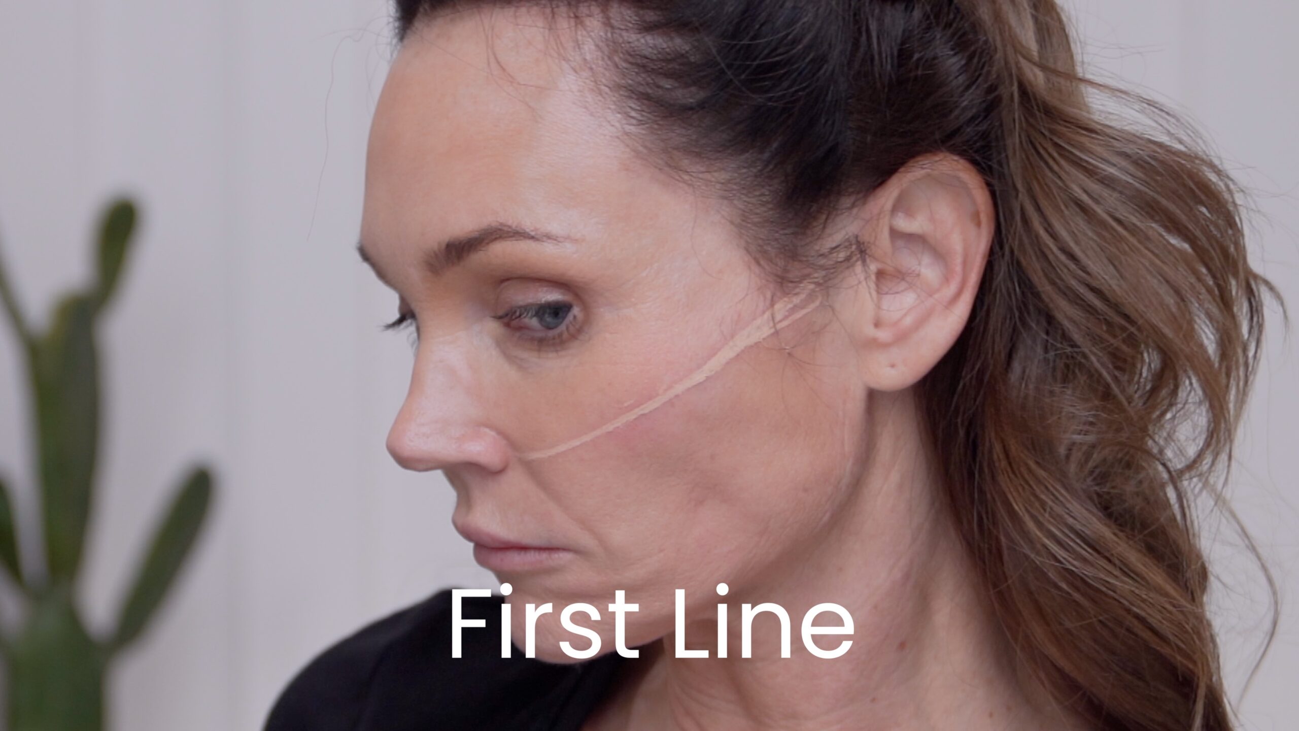 First marking line shown on Kimberly’s cheek before her December 2025 treatment