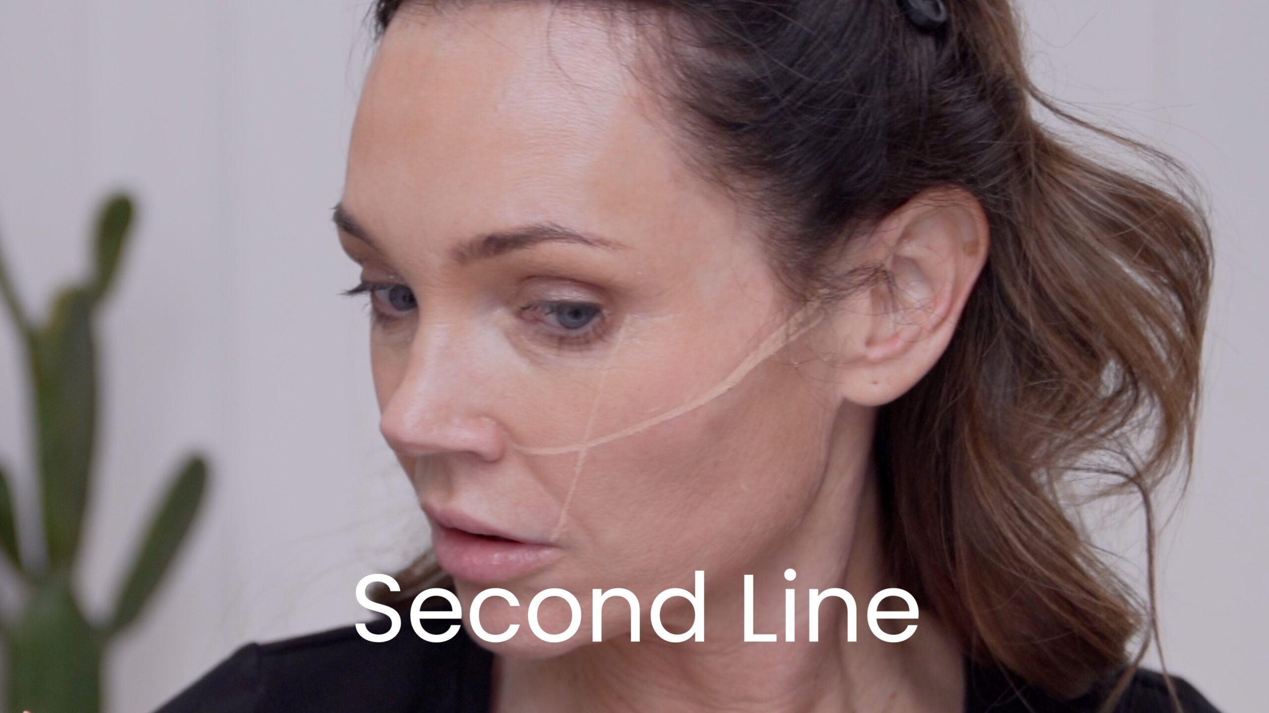 Second marking line added to Kimberly’s cheek in the treatment footage