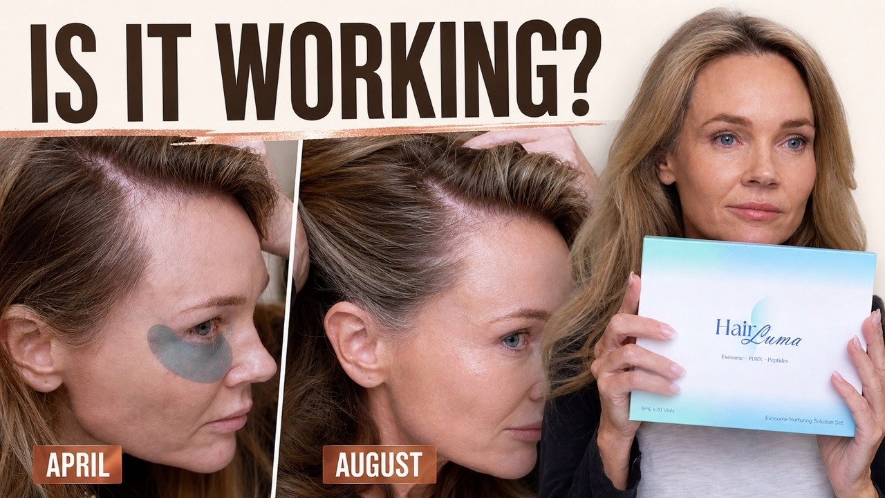My HairLuma Scalp Microneedling Routine: 4-Month Hair Progress