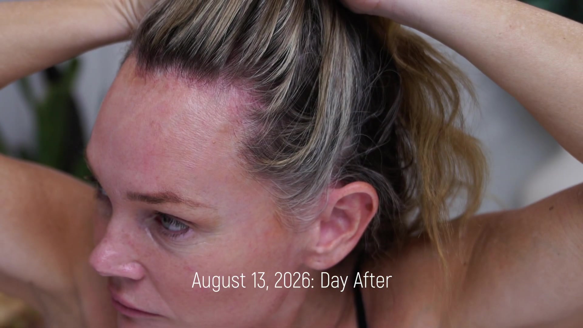 Close-up of Kim's pink hairline the morning after her HairLuma scalp treatment