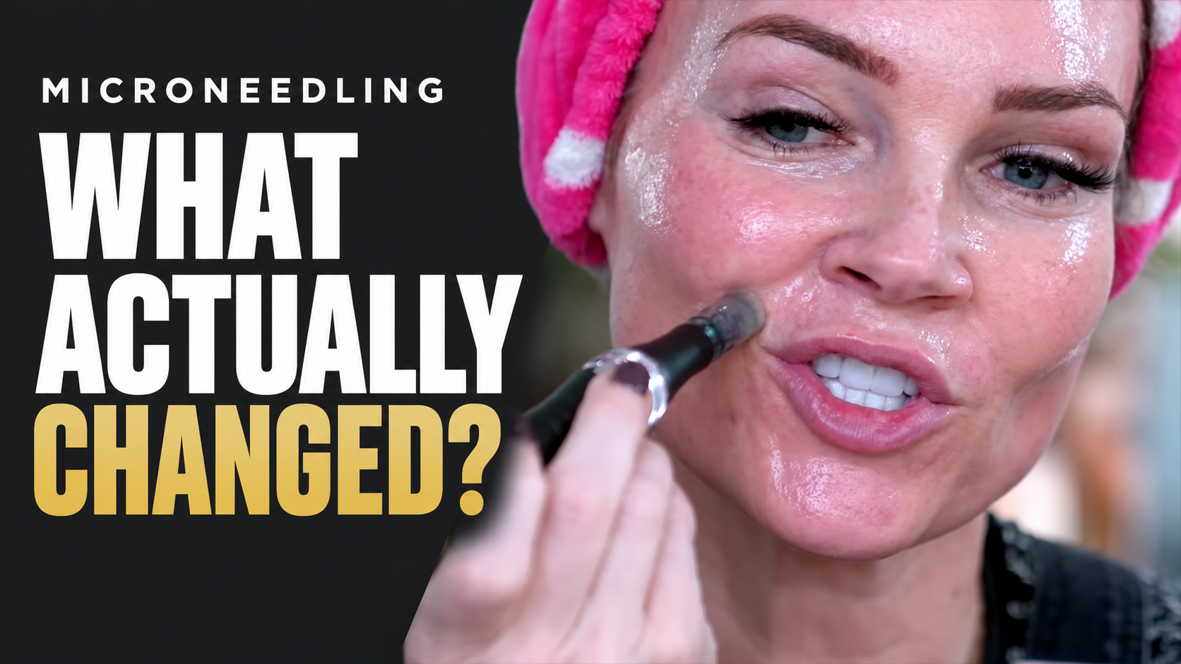 Years of Microneedling: What Changed—and What I Still Can’t Prove