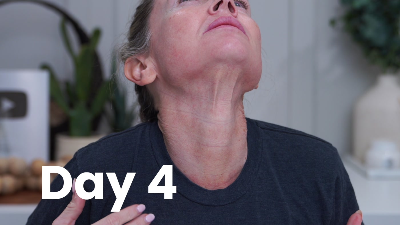 Day 4 video check-in with Kim looking upward to show her neck